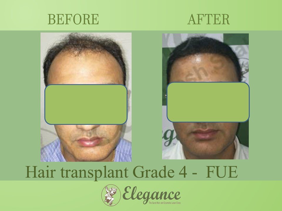 Grade 4 in Hair Transplant, Navsari, Gujarat, India.