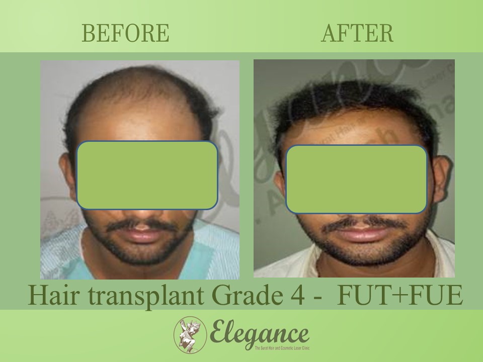 Grade 4 in Hair Transplant, Selvasa, Gujarat, India.