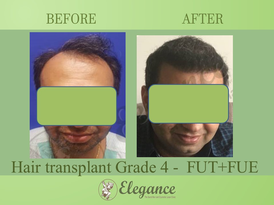 Grade 4 in Hair Transplant, Surat, Gujarat, India.