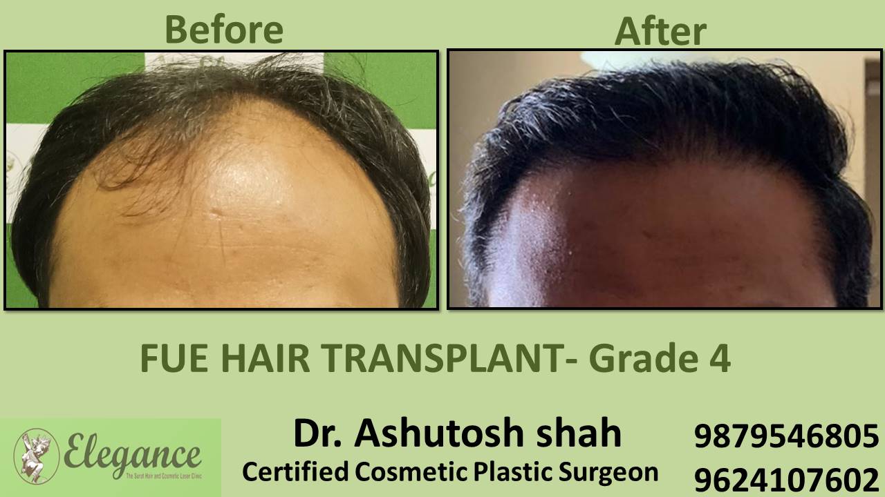 Grade 4 in Hair Transplant Treatment, Bharuch, Gujarat, India.