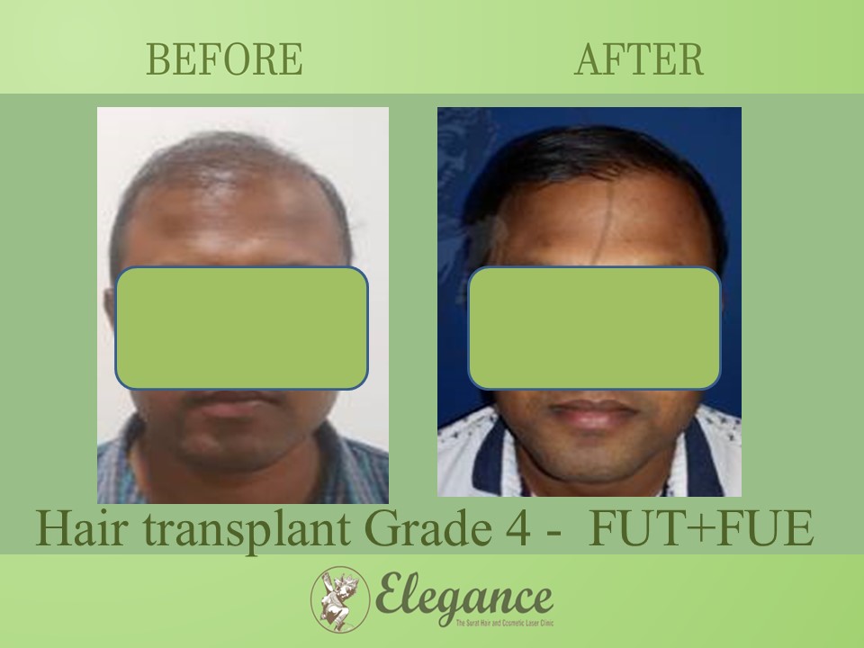 Grade 4 in Hair Transplant, Valsad, Gujarat, India.