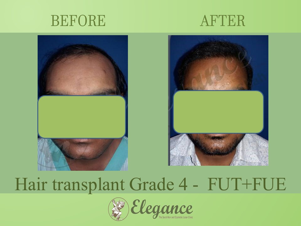 Grade 4 in Hair Transplant, Vapi, Gujarat, India.