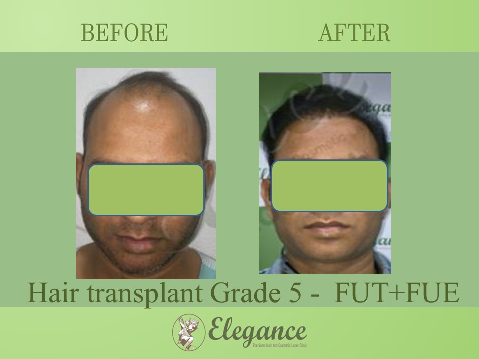 Grade 5 in Hair Transplant, Bardoli, Gujarat, India.