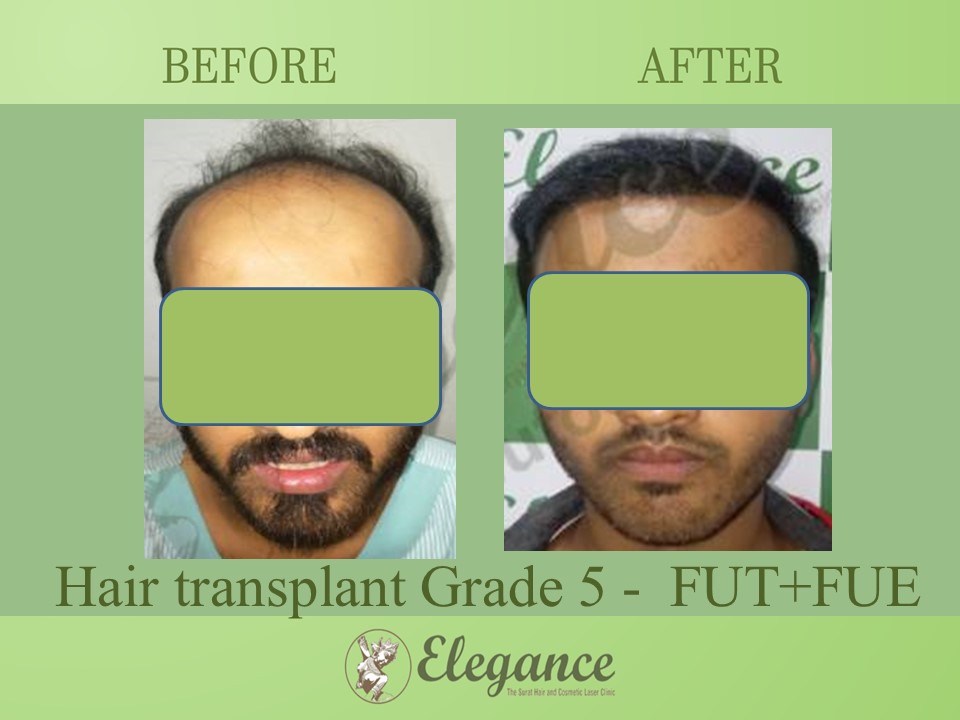 Grade 5 in Hair Transplant, Bilimora, Gujarat, India.