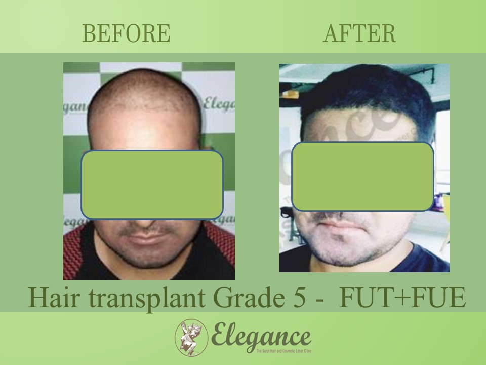 Grade 5 in Hair Transplant, Chikhli, Gujarat, India.