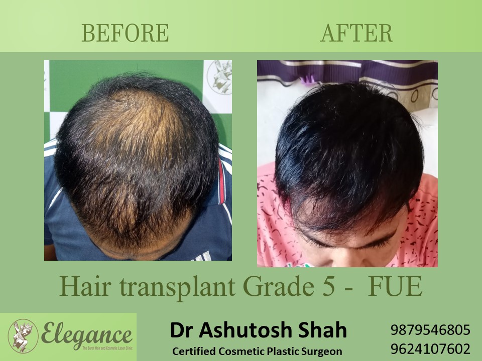 Grade 5 in Hair Transplant, Kim, Gujarat, India.