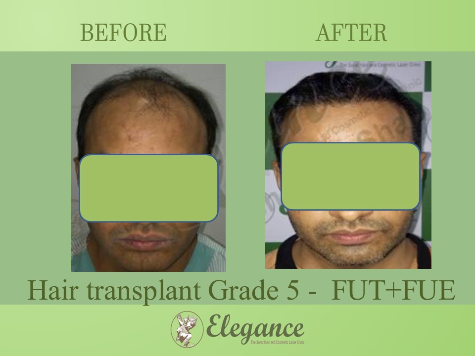 Grade 5 in Hair Transplant, Kosamba, Gujarat, India.