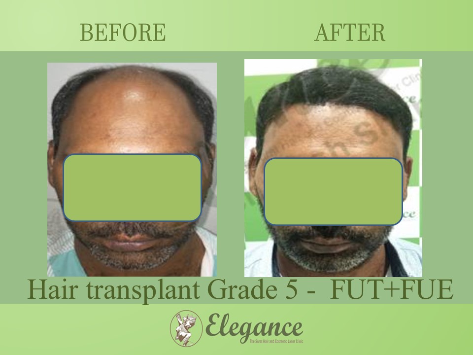 Grade 5 in Hair Transplant, Mangrol, Gujarat, India.