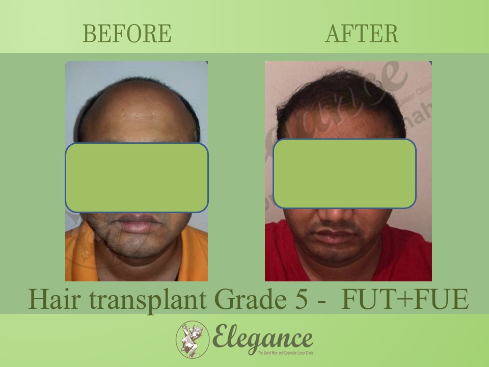 Grade 5 in Hair Transplant, Selvasa, Gujarat, India.