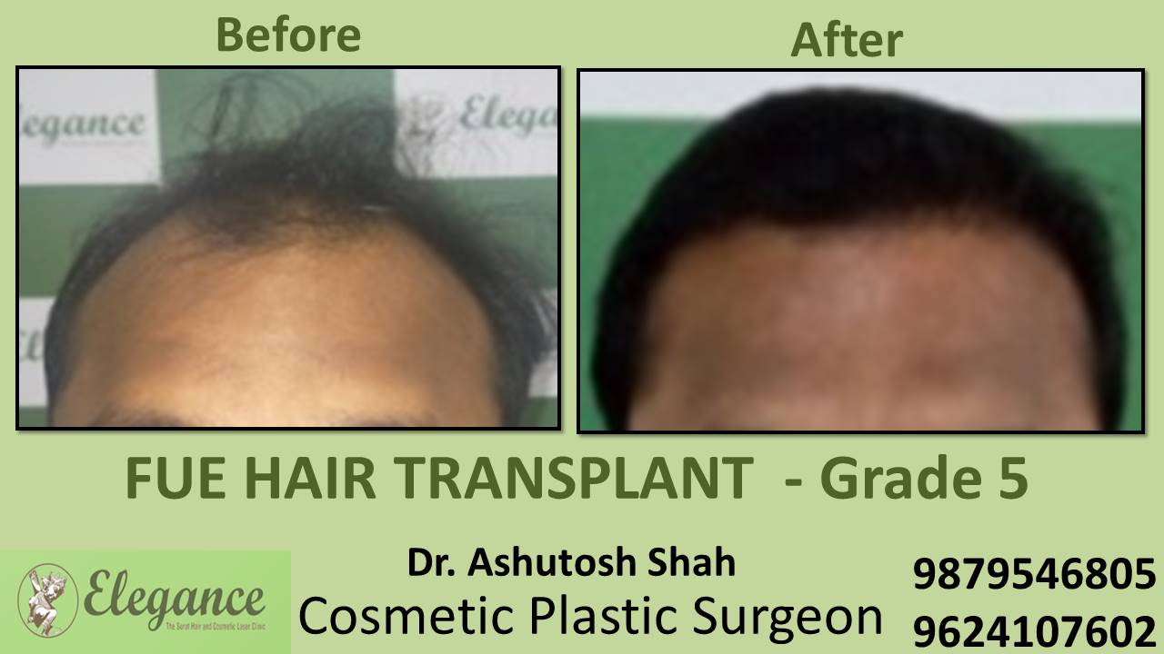 Grade 5 in Hair Transplant Treatment  Mangrol, Gujarat, India.