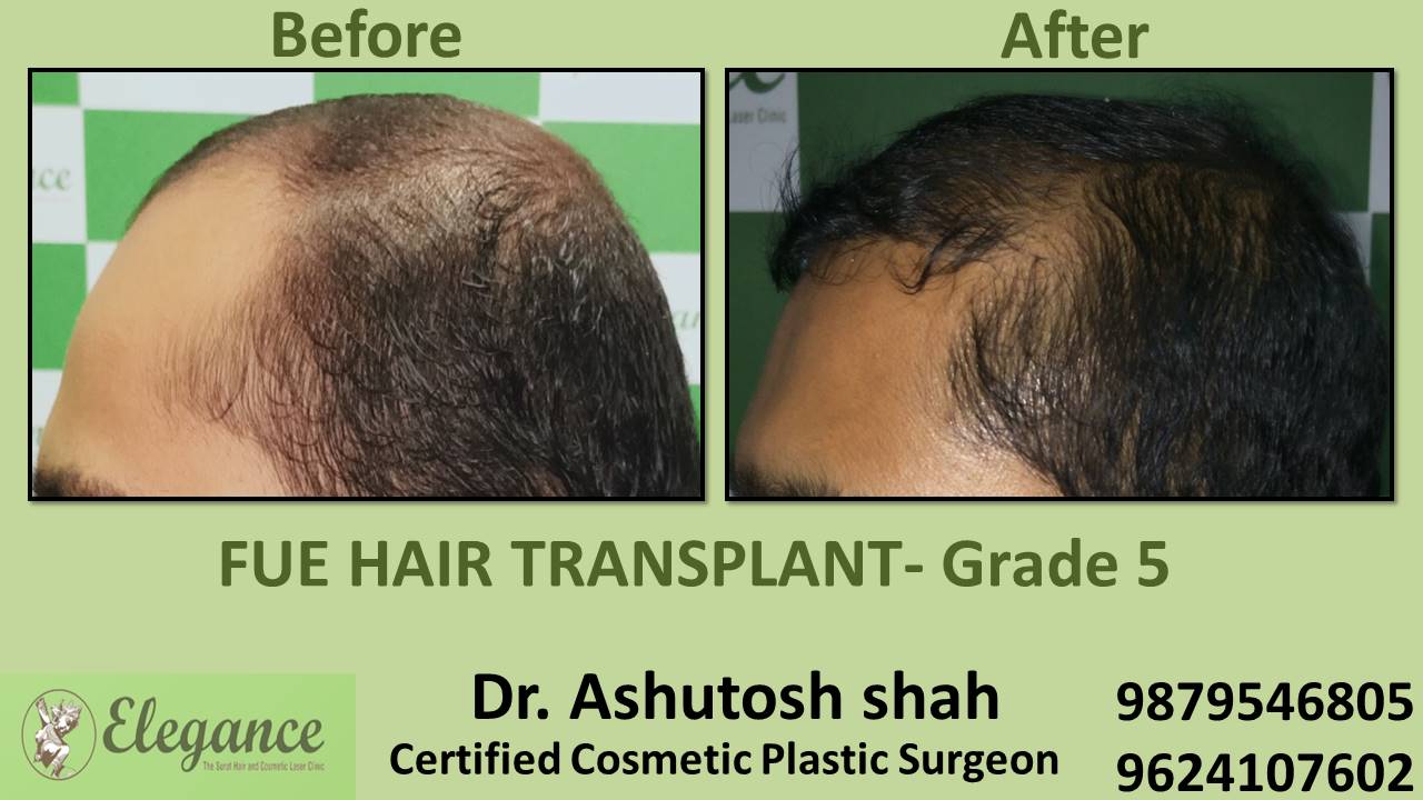 Grade 5 in Hair Transplant Treatment Valsad, Gujarat, India.