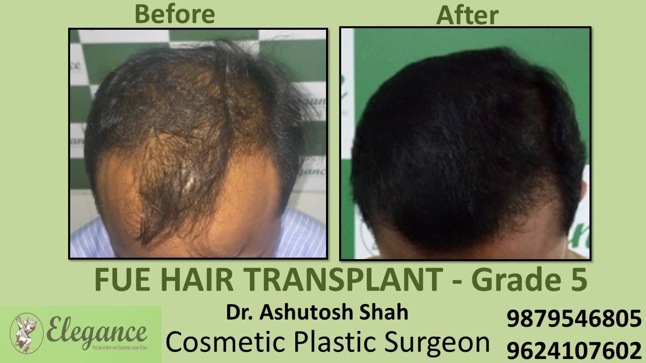 Grade 5 in Hair Transplant Treatment Vapi, Gujarat, India.