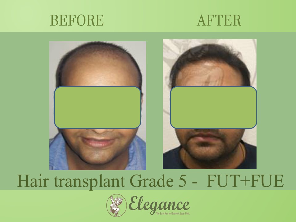 Grade 5 in Hair Transplant, Vadodara, Gujarat, India.