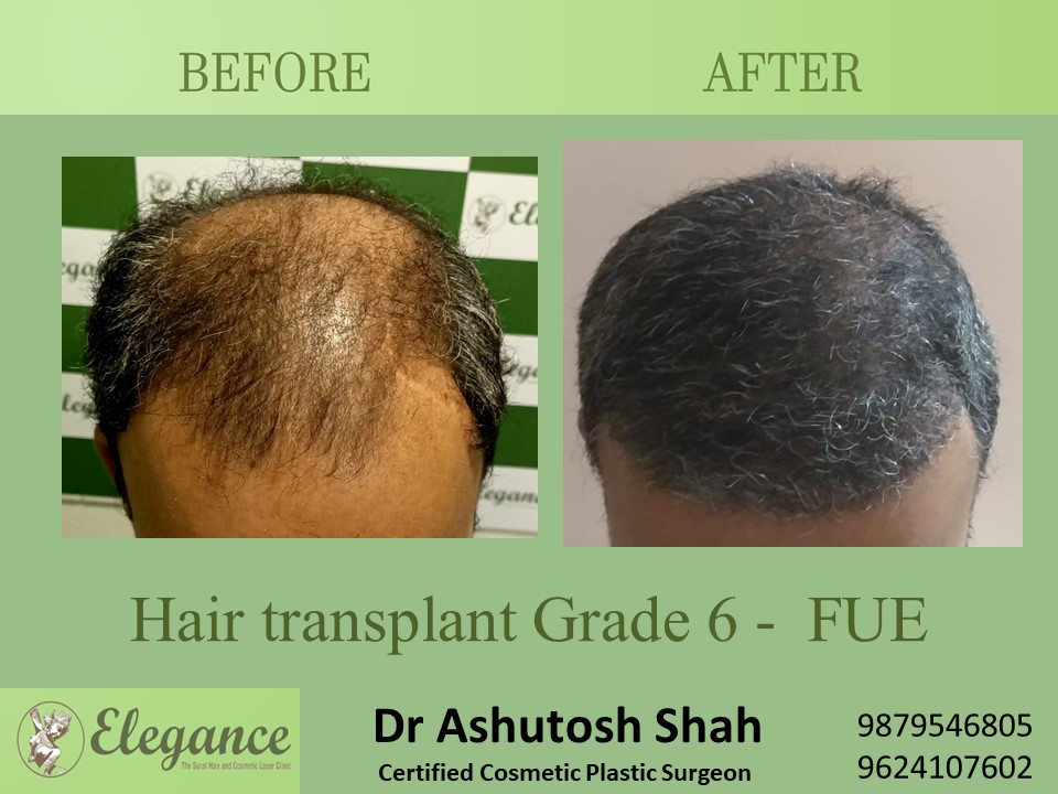 Grade 6 in Hair Transplant, Navsari, Gujarat, India.