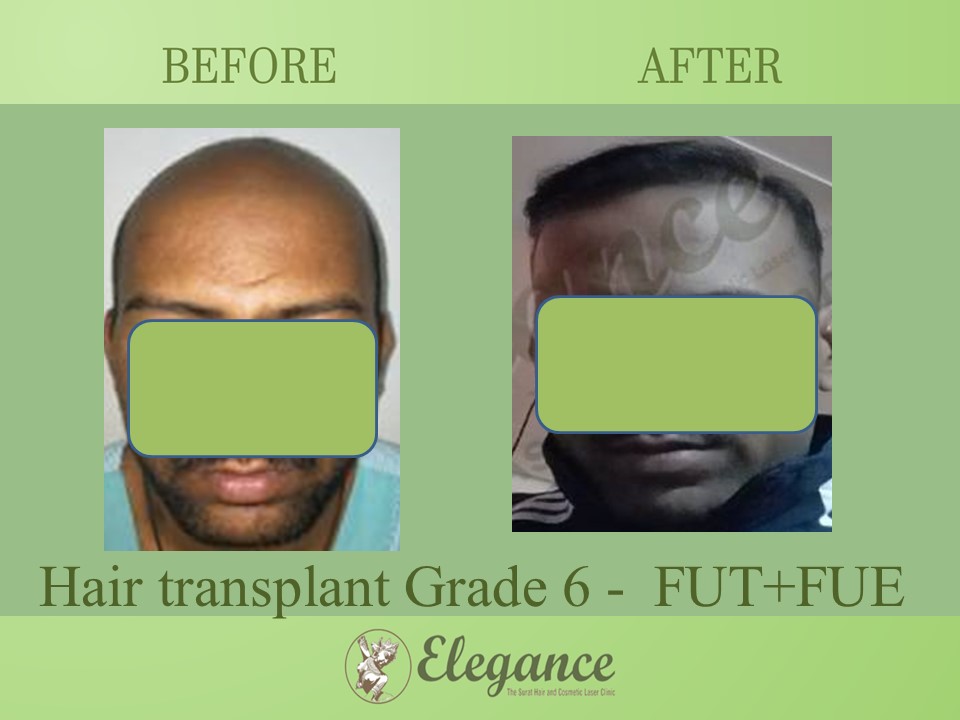 Grade 6 in Hair Transplant, Selvasa, Gujarat, India.