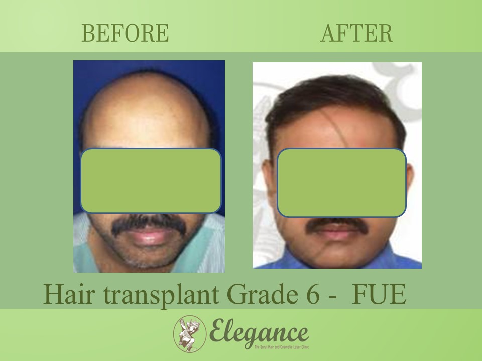 Grade 6 in Hair Transplant, Surat, Gujarat, India.