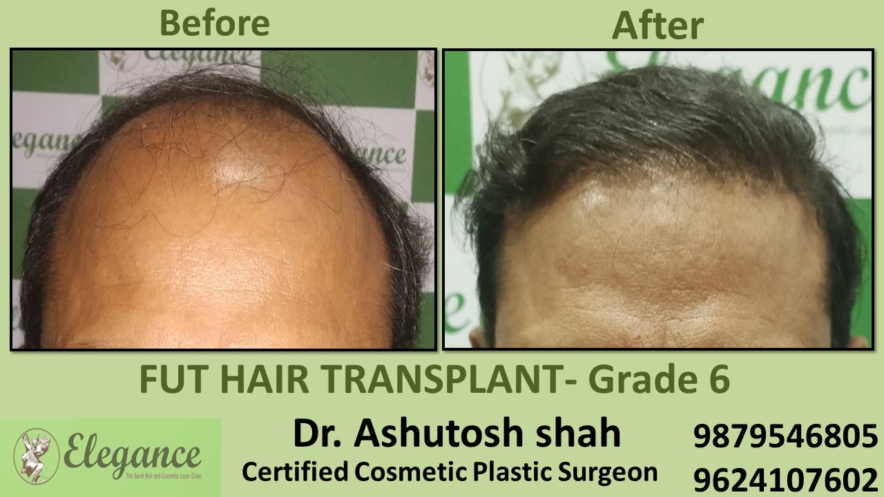 Grade 6 in Hair Transplant Treatment Surat, Gujarat, India.
