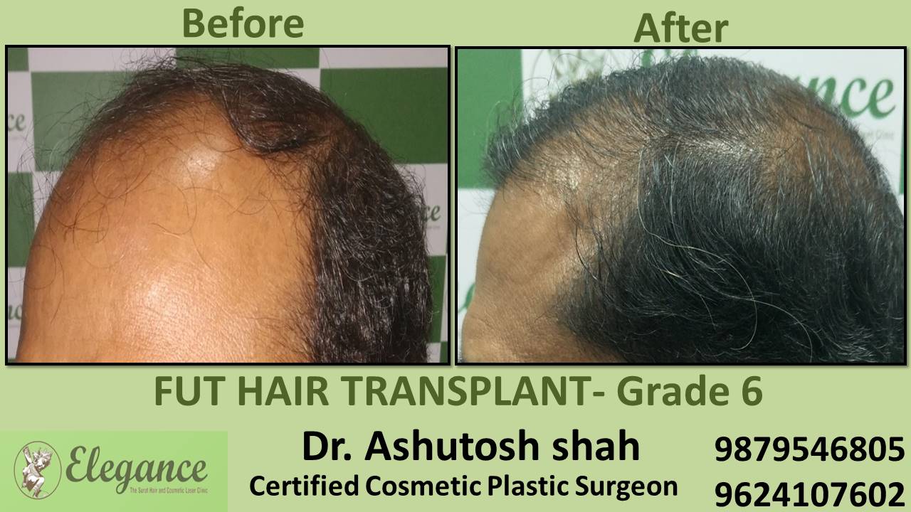 Grade 6 in Hair Transplant Treatment Vapi, Gujarat, India.