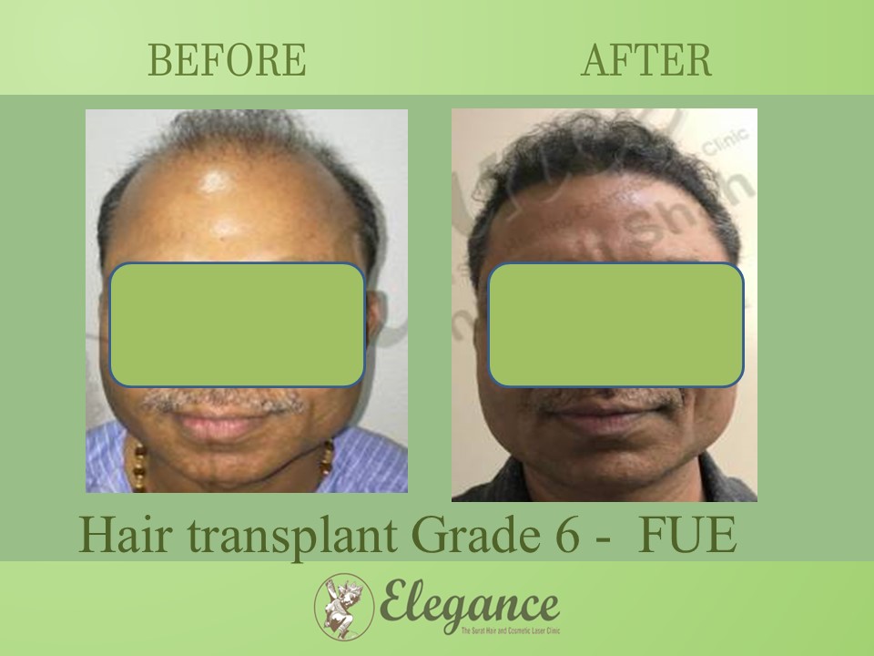 Grade 6 in Hair Transplant, Valsad, Gujarat, India.
