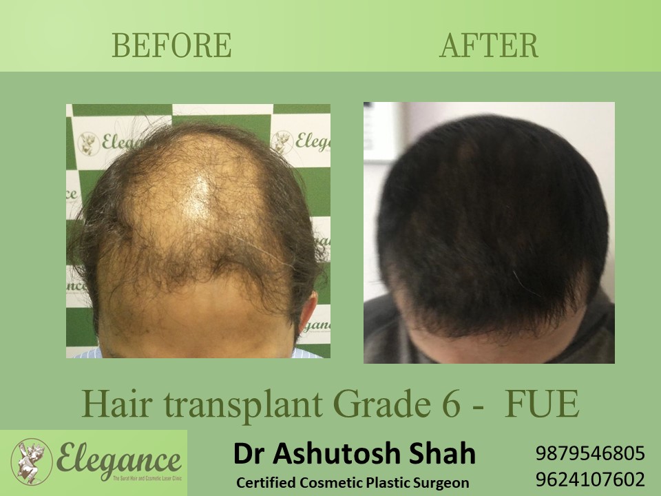 Grade 6 in Hair Transplant, Vapi, Gujarat, India.