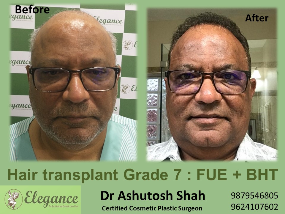 Grade 7 in Hair Transplant, Chikhli, Gujarat, India.