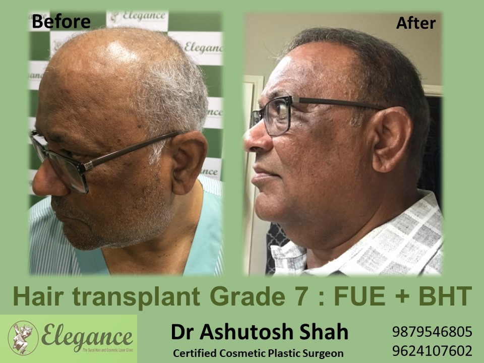 Grade 7 in Hair Transplant, Mangrol, Gujarat, India.