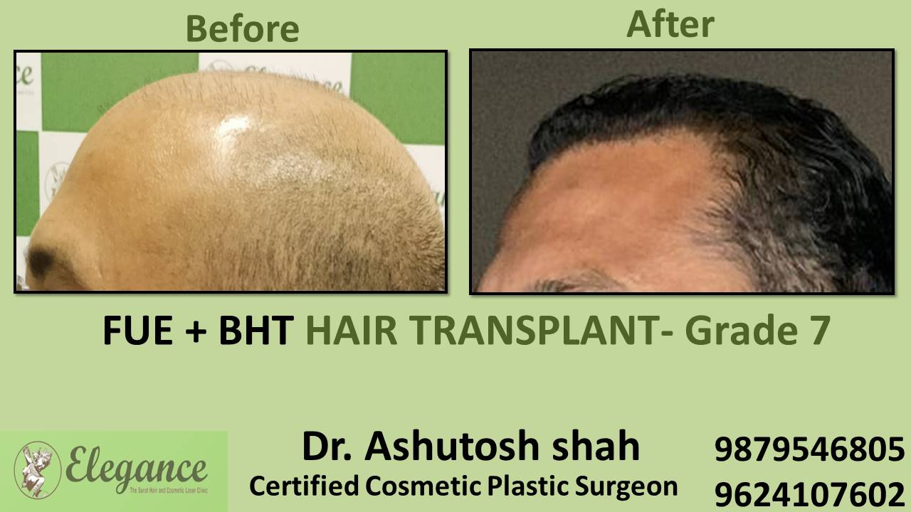 Grade 7 in Hair Transplant Treatment Bilimora, Gujarat, India.