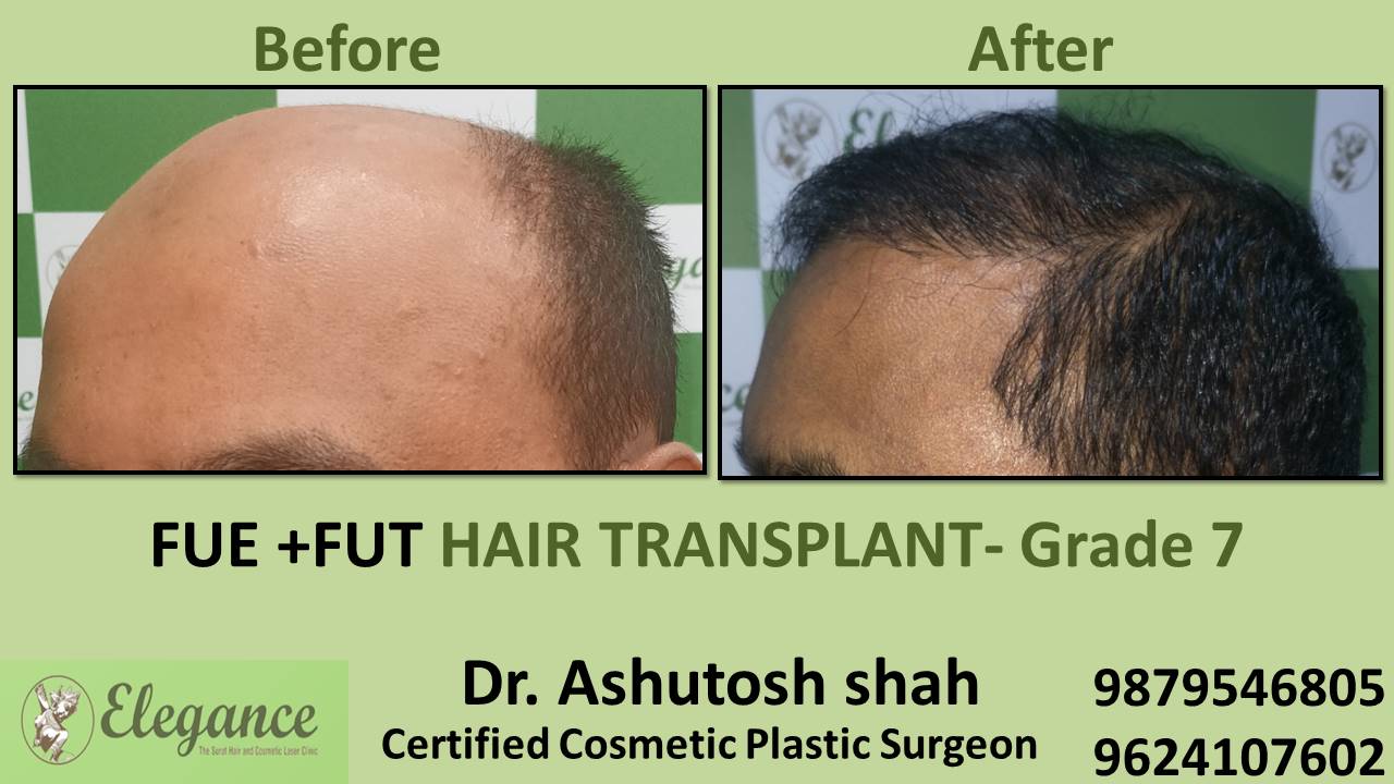 Grade 7 in Hair Transplant Treatment Kosamba, Gujarat, India.