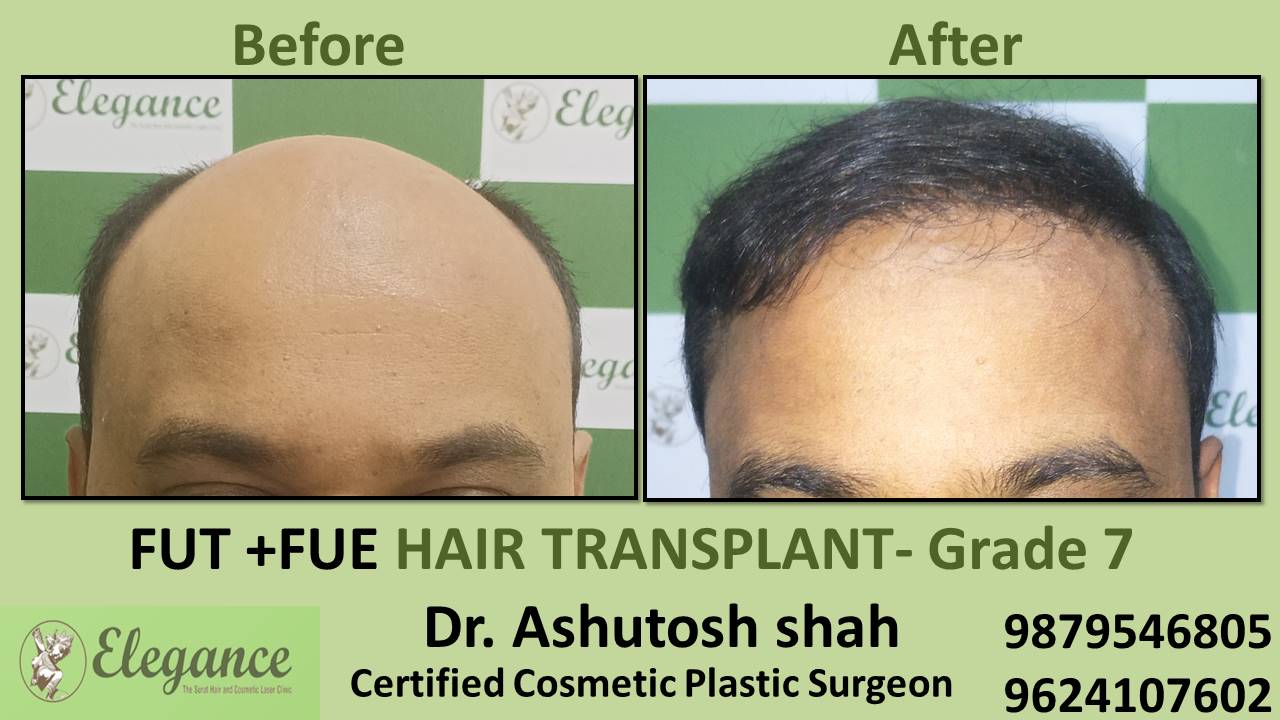 Grade 7 in Hair Transplant Treatment Surat, Gujarat, India.