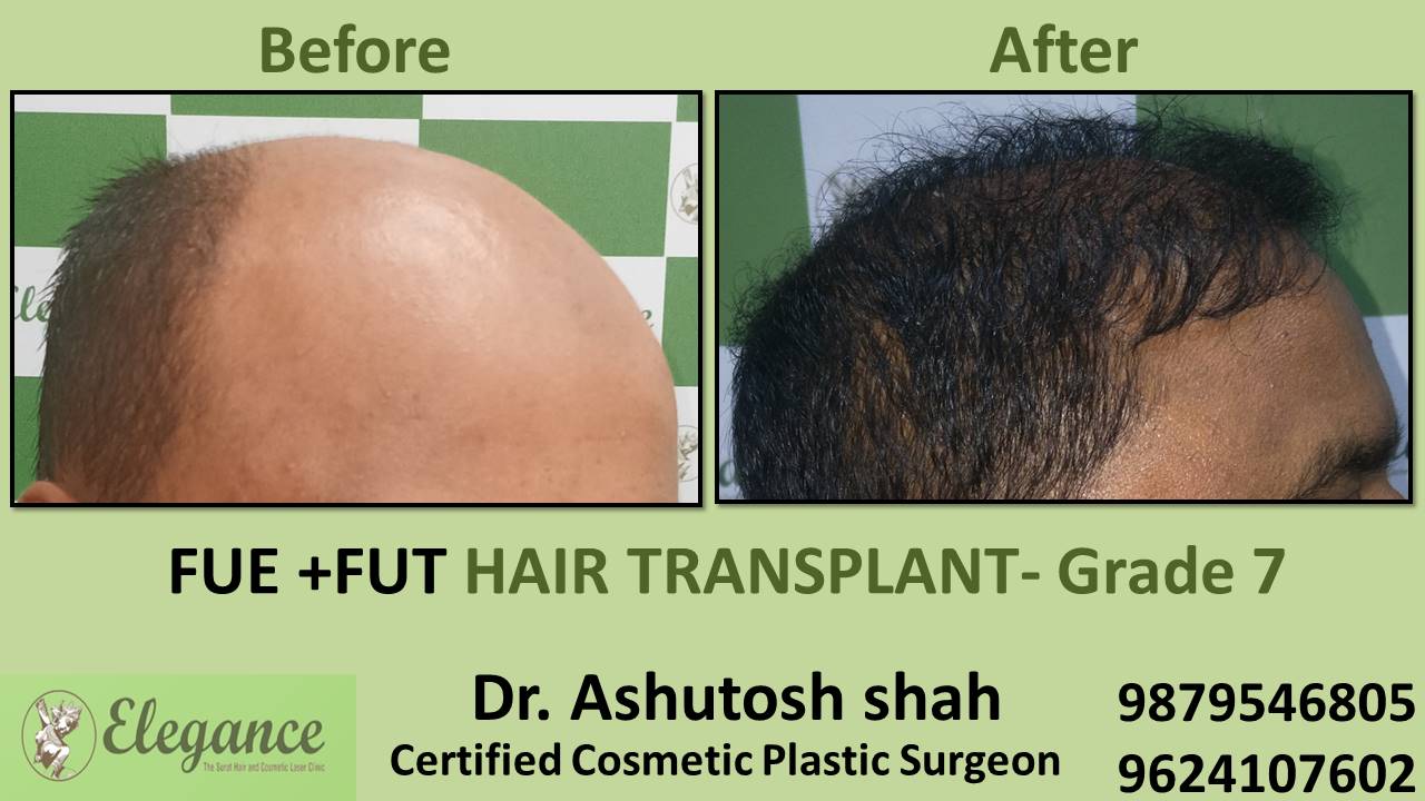 Grade 7 in Hair Transplant Treatment Vapi, Gujarat, India.