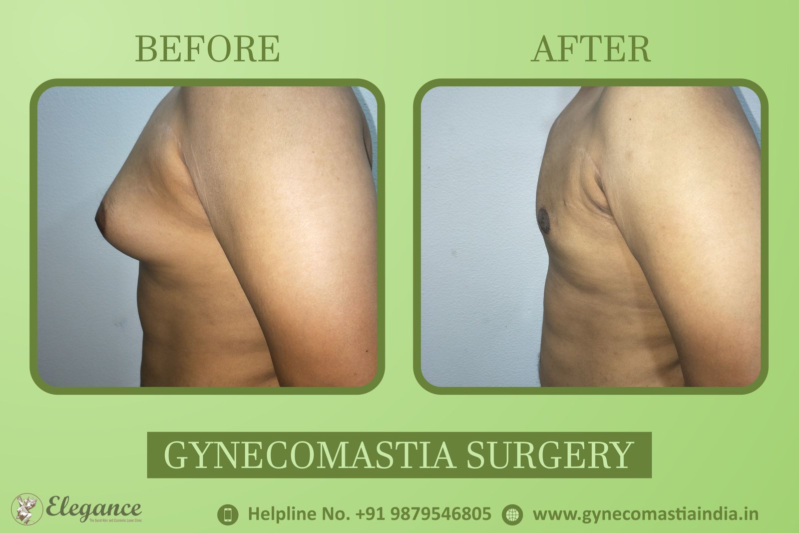 Gynecomastia Clinic in Bardoli, Gujarat, india