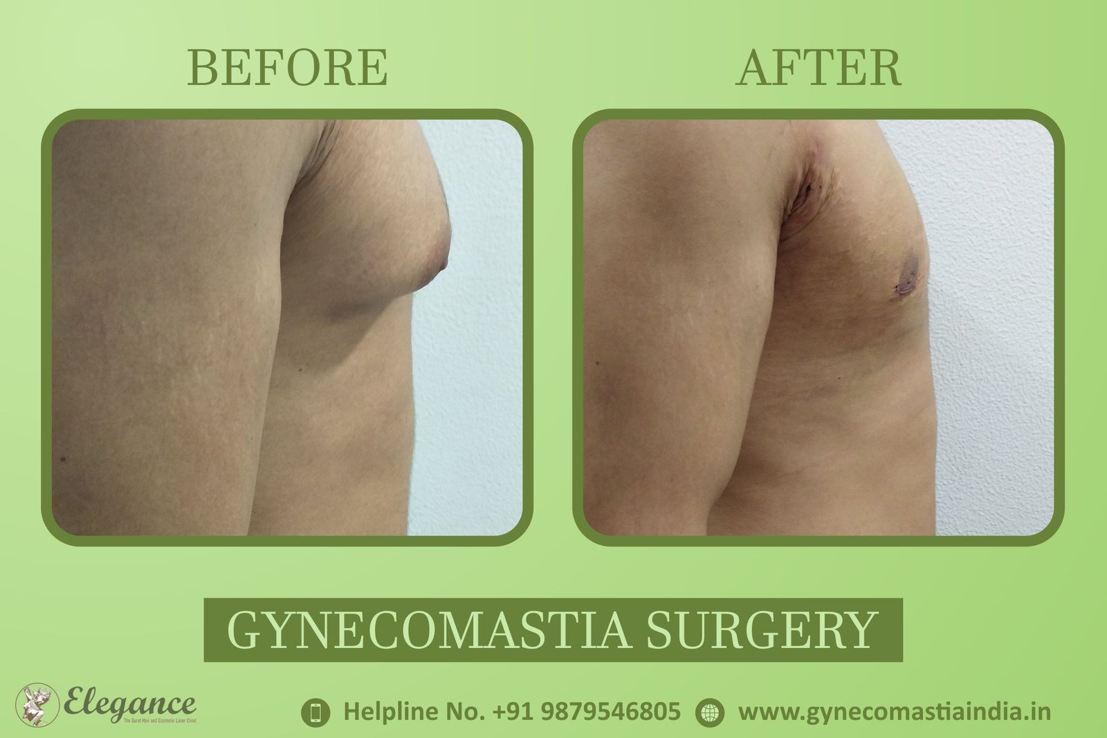 Gynecomastia Cost in Bardoli, Gujarat, india