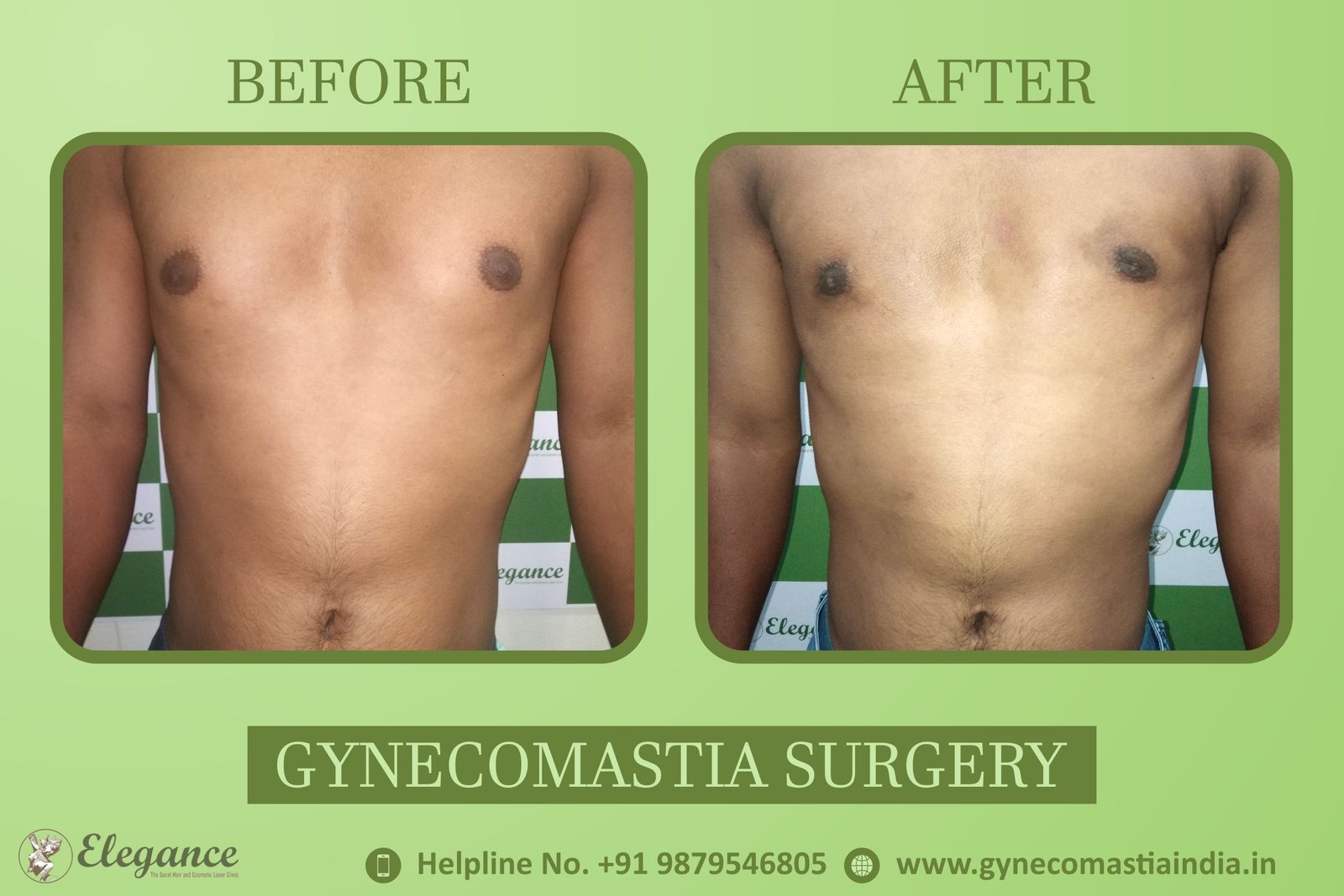 Gynecomastia Cost in Surat, Gujarat, india