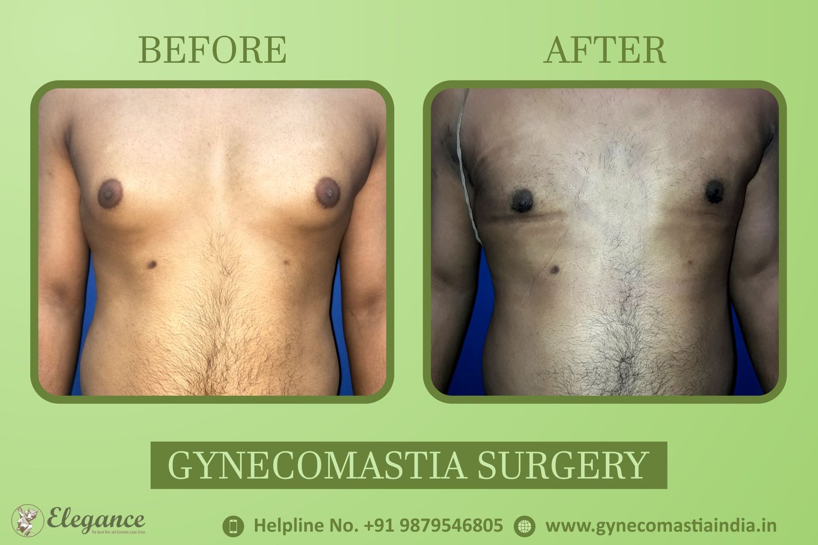 Gynecomastia Cost in Valsad, Gujarat, india