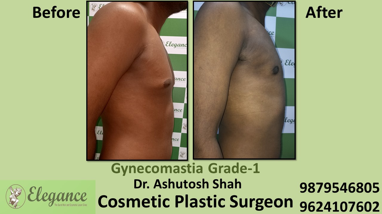 Gynecomastia Grade-1 Puffy Nipples in Male Surgery, Vadodara, Gujarat, India.