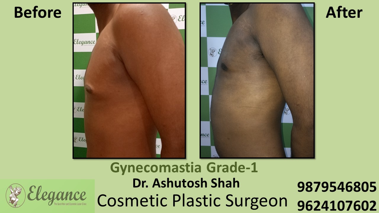 Gynecomastia Grade-1 Puffy Nipples in Male Surgery, Valsad, Gujarat, India.