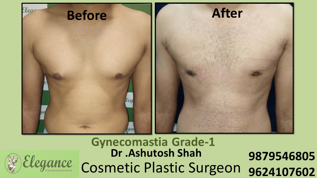 Gynecomastia Grade-1 Puffy Nipples in Male Surgery, Vapi, Gujarat, India.