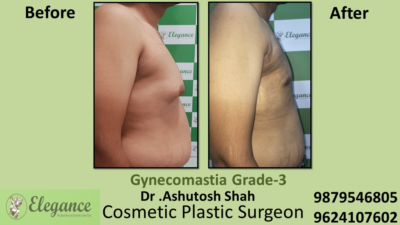 Gynecomastia Grade-3, Slight Breast Roll Surgery, Bardoli, Gujarat, India.