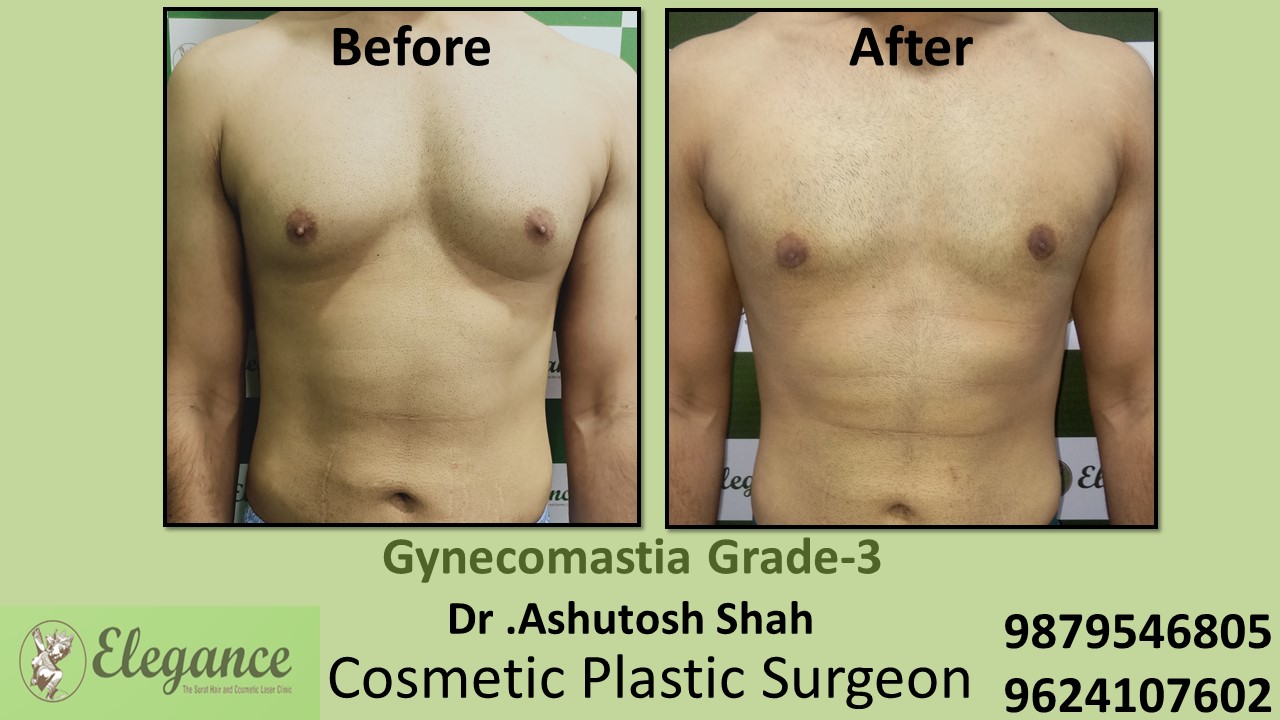 Gynecomastia Grade-3, Slight Breast Roll Surgery, Daman, Gujarat, India.