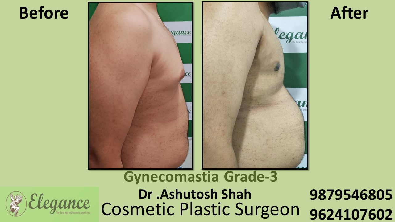Gynecomastia Grade-3, Slight Breast Roll Surgery, Kim, Gujarat, India.