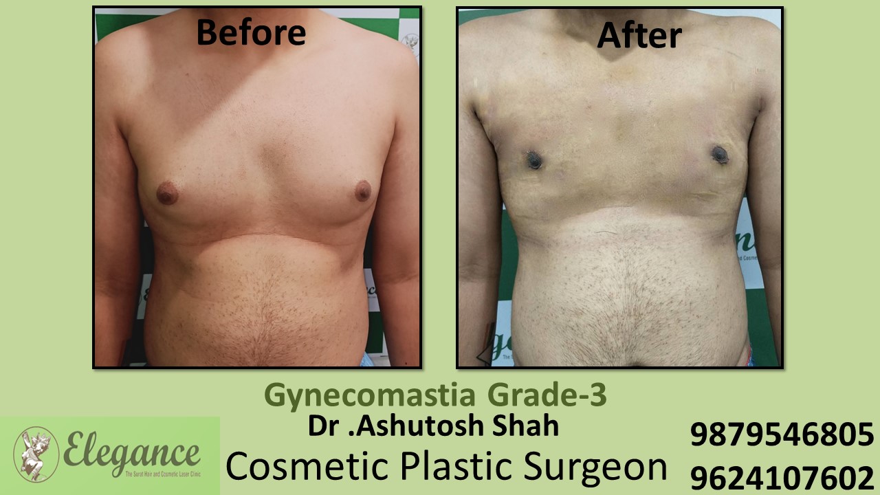 Gynecomastia Grade-3, Slight Breast Roll Surgery, Kosamba, Gujarat, India.
