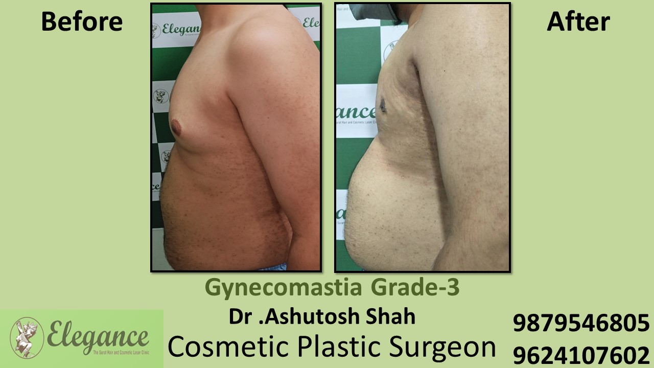Gynecomastia Grade-3, Slight Breast Roll Surgery, Mangrol, Gujarat, India.