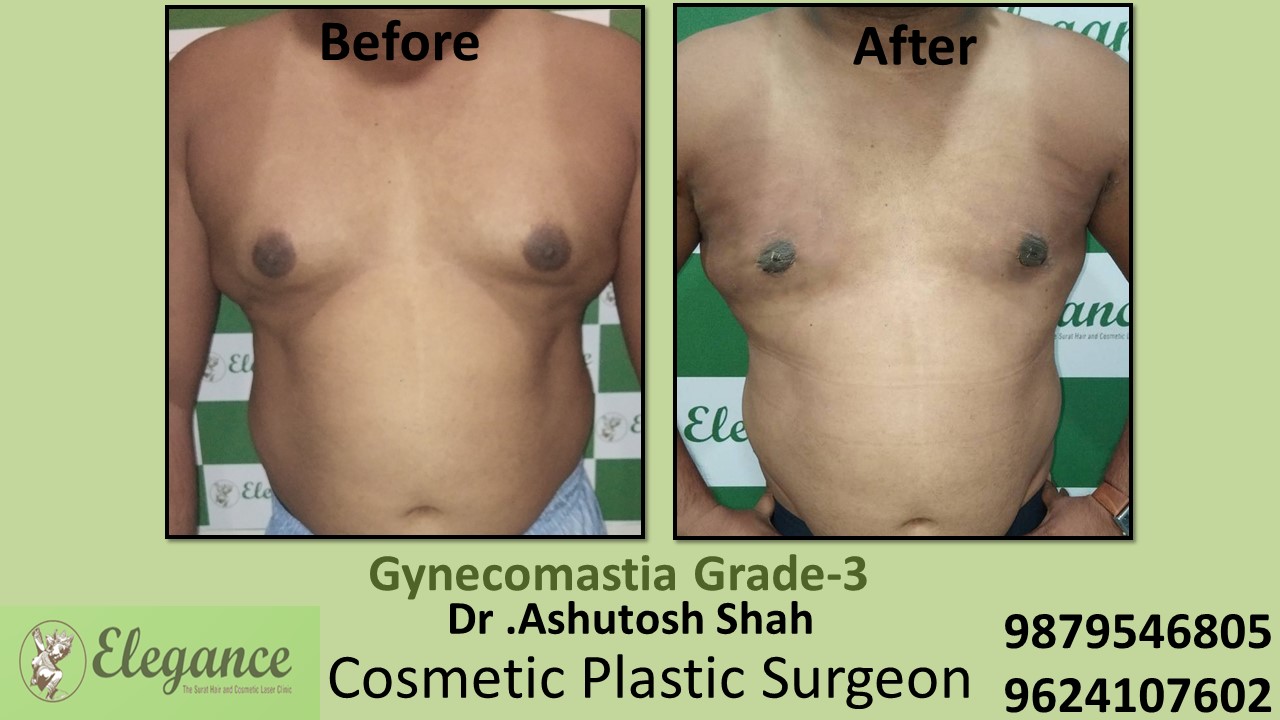 Gynecomastia Grade-3, Slight Breast Roll Surgery, Navsari, Gujarat, India.