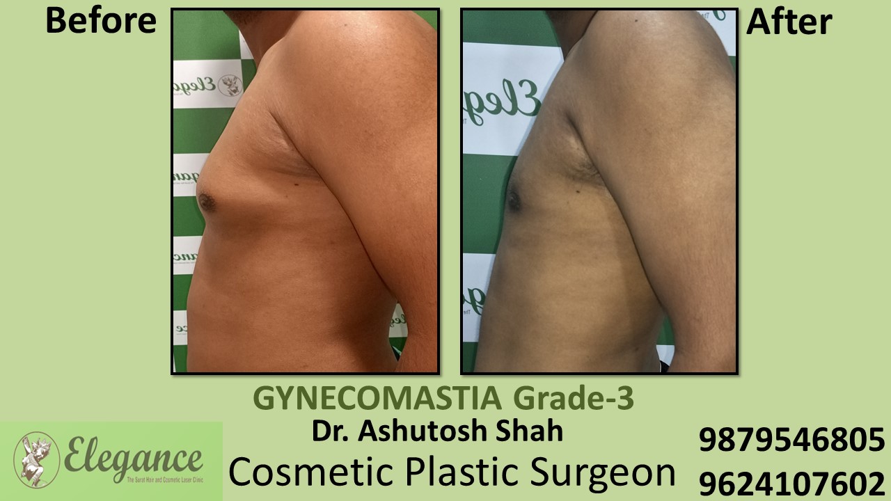 Gynecomastia Grade-3, Slight Breast Roll Surgery, Selvasa, Gujarat, India.