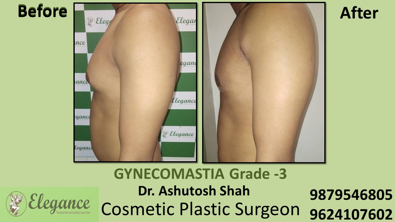Gynecomastia Grade-3, Slight Breast Roll Surgery, Surat, Gujarat, India.