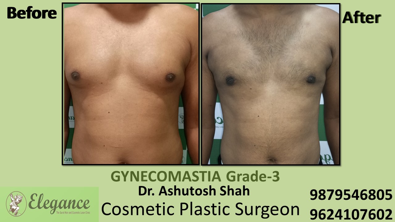 Gynecomastia Grade-3, Slight Breast Roll Surgery, Valsad, Gujarat, India.