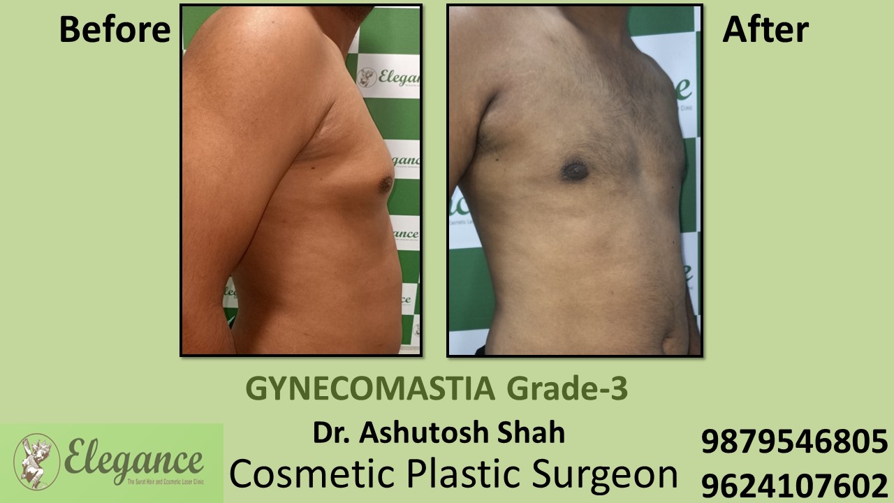Gynecomastia Grade-3, Slight Breast Roll Surgery, Vapi, Gujarat, India.
