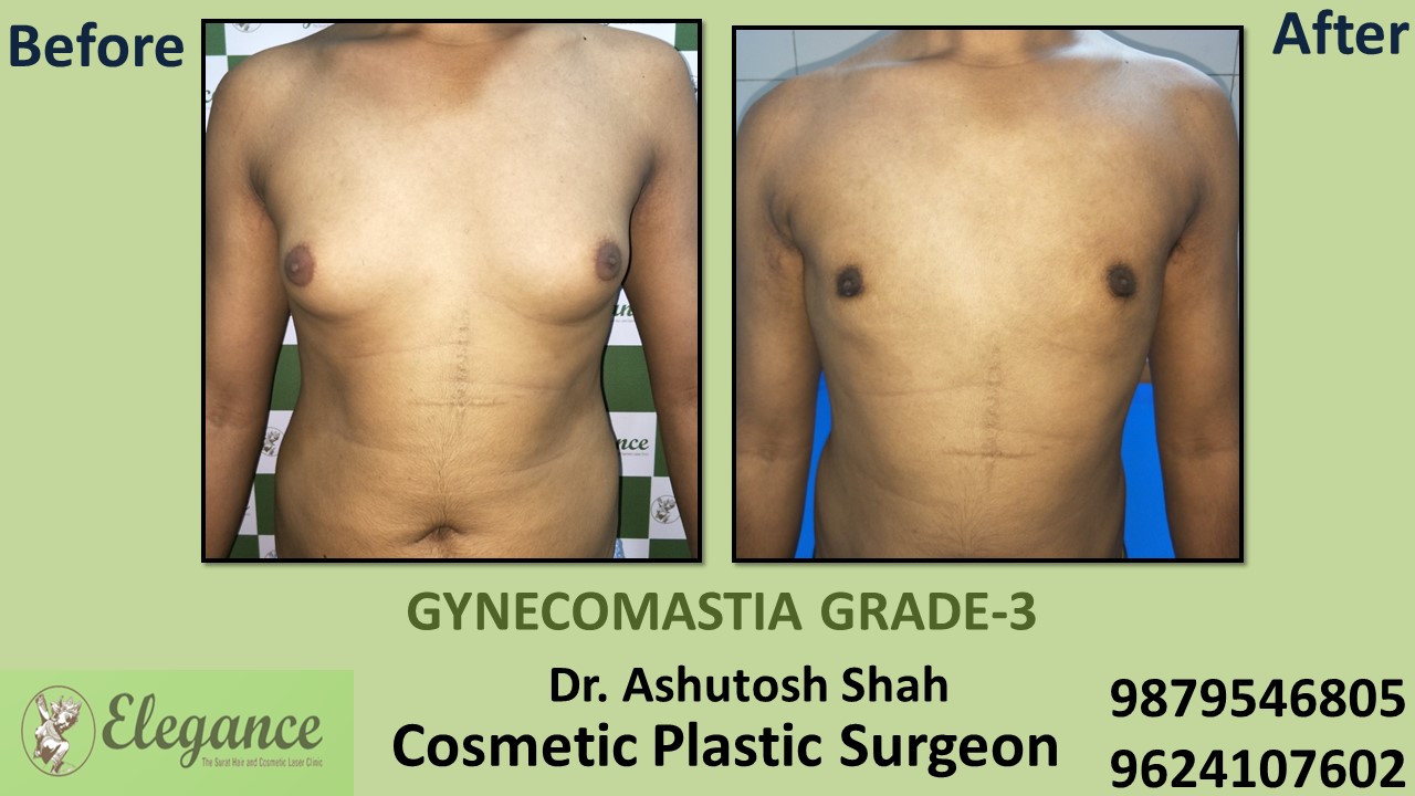 Gynecomastia Grade-3 Treatment, Athwaget, Surat, Gujarat.