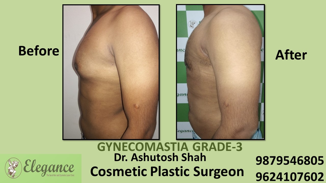 Gynecomastia Grade-3 Treatment, Bharuch, Gujarat, India.