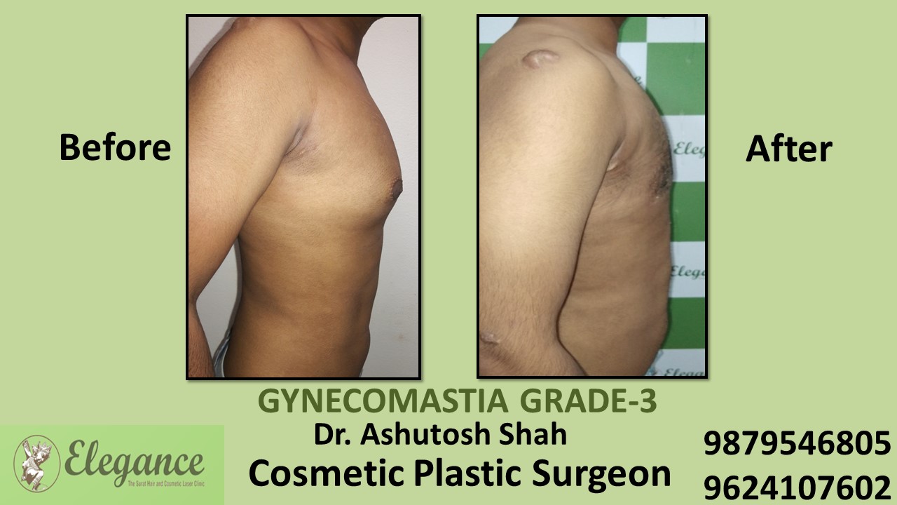 Gynecomastia Grade-3 Treatment, Bilimora, Gujarat, India.